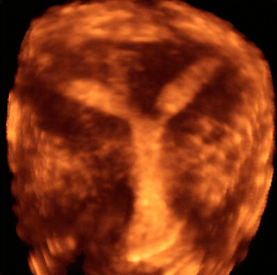 Deformed uterus,3-D ultrasound scan