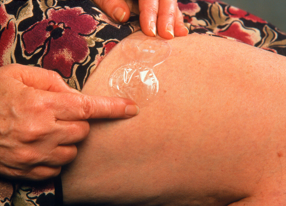 Hormone Replacement Therapy: skin patch on thigh