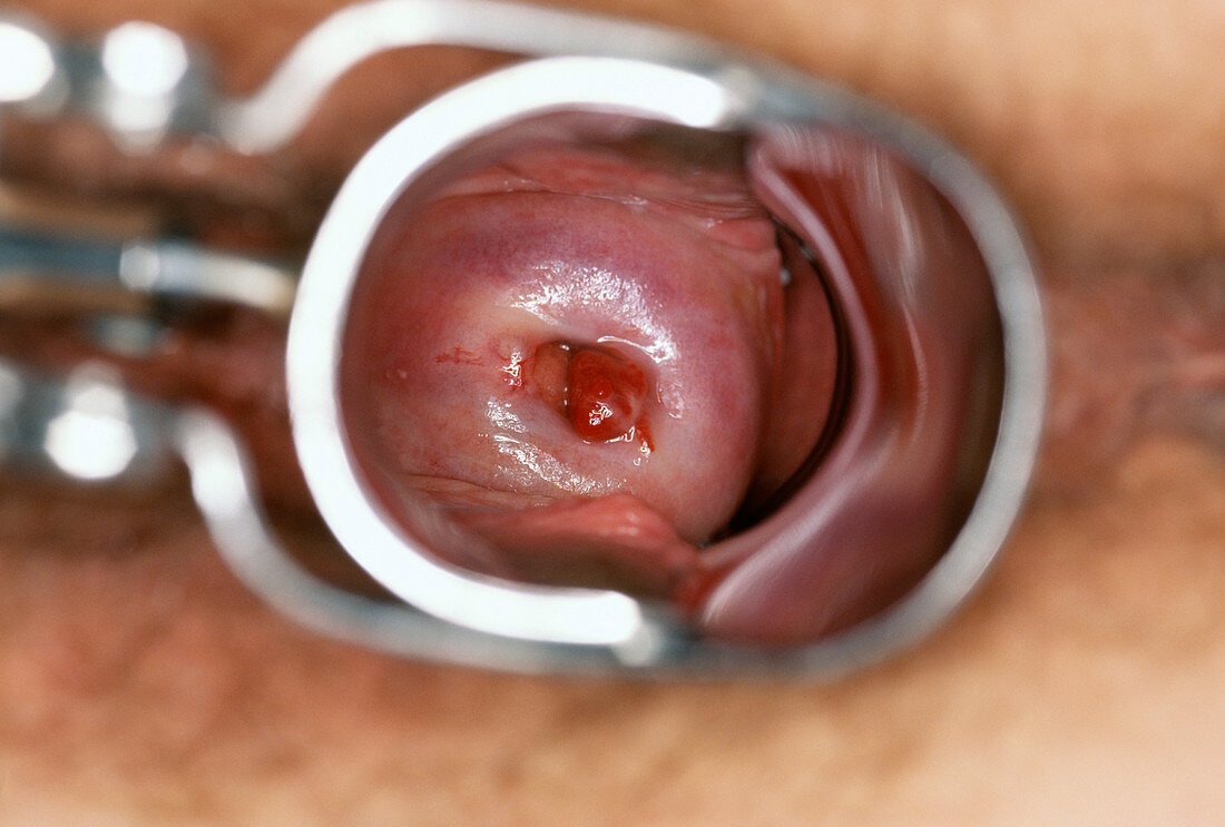Cervical polyp
