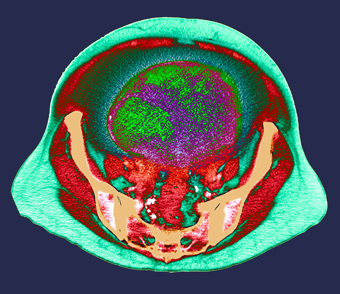 Ovarian cancer,CT scan