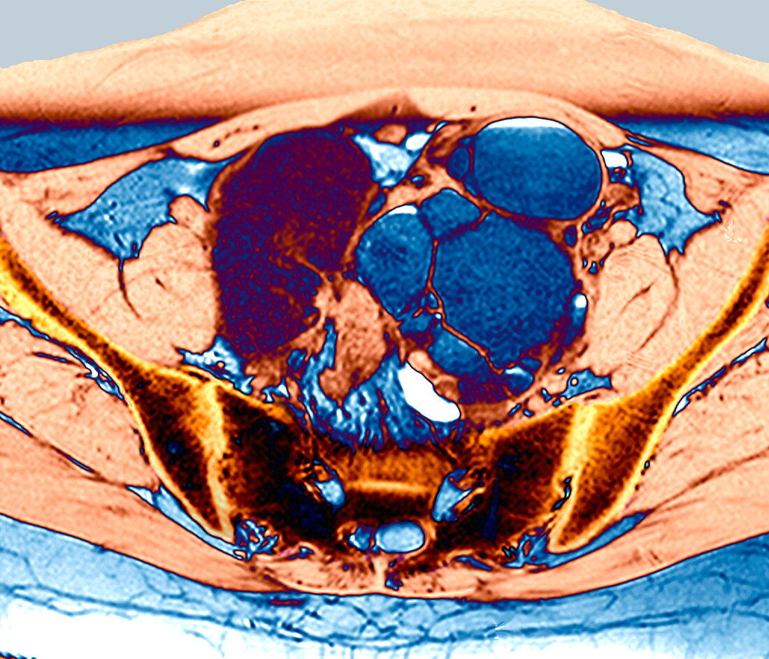 Endometriosis and ovarian cyst,MRI