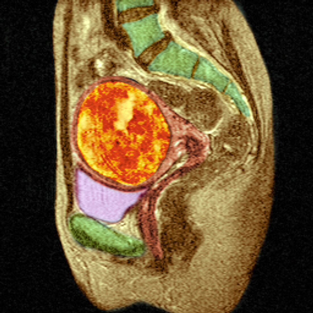 Uterine fibroid,MRI scan