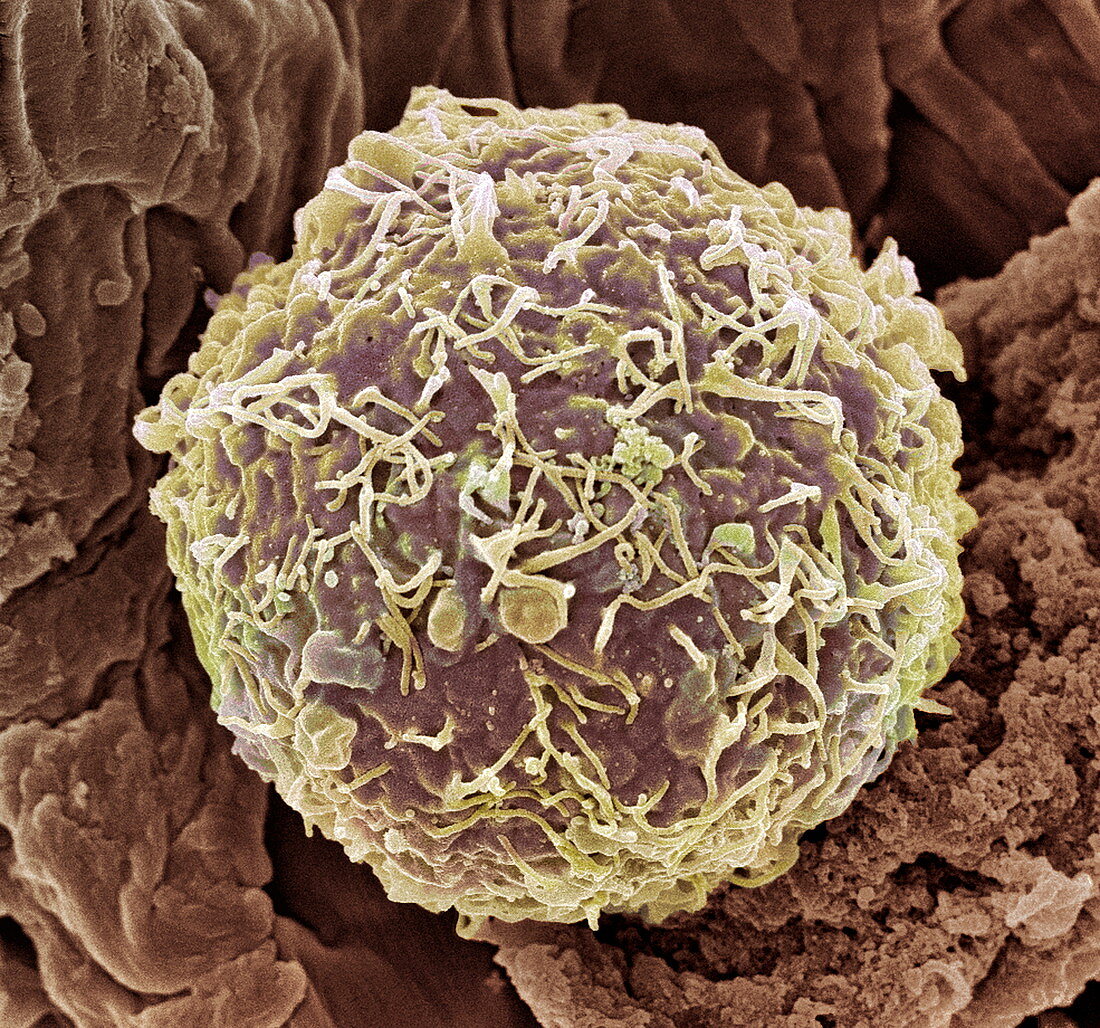 Cervical cancer cell,SEM