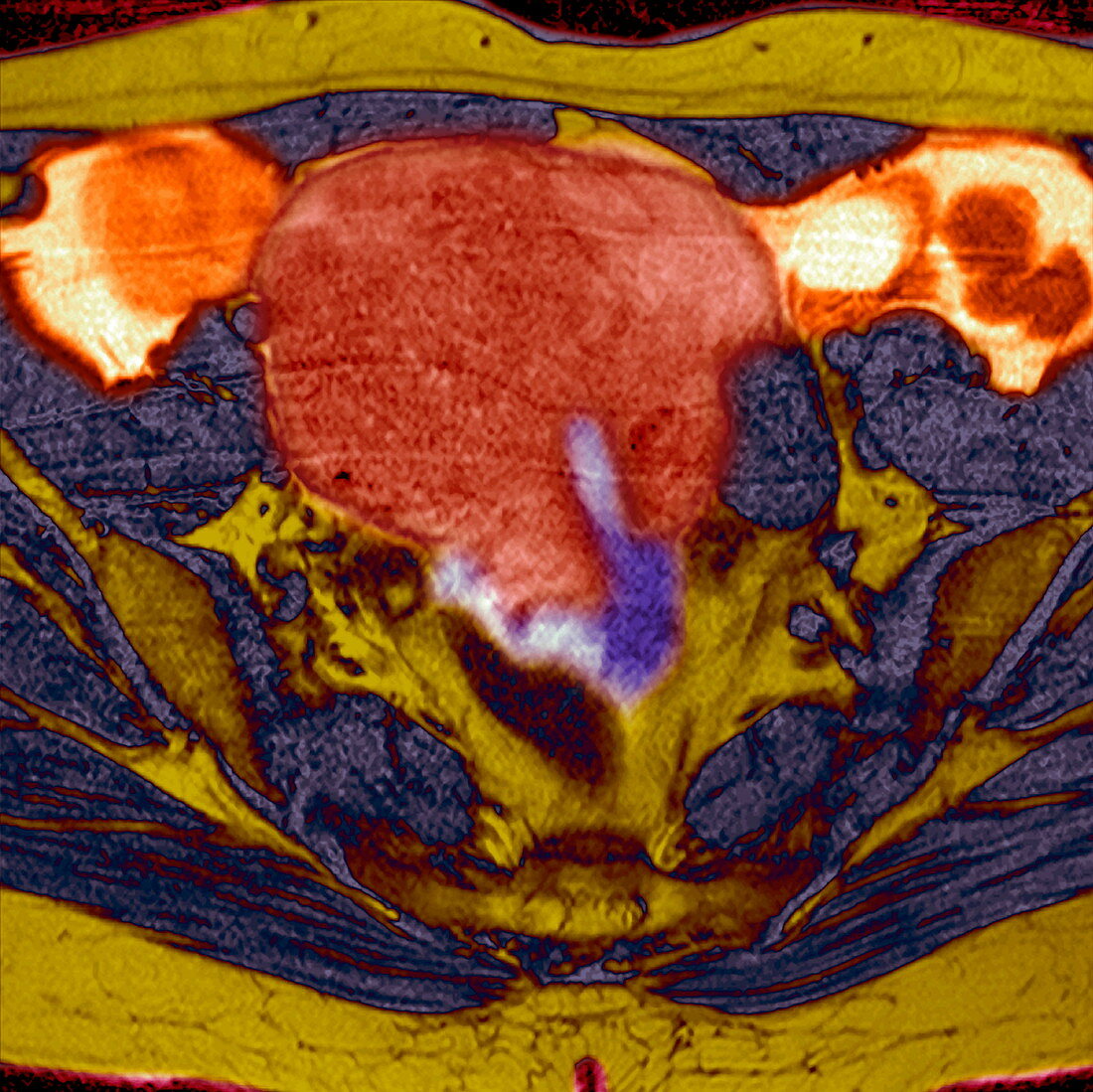 Uterine fibroid,MRI scan