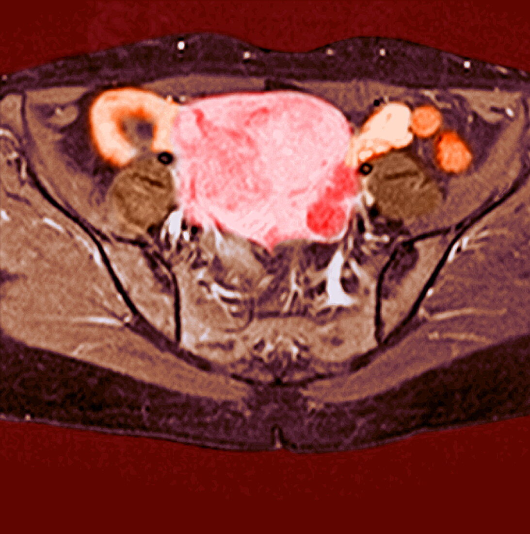 Uterine fibroid,MRI scan