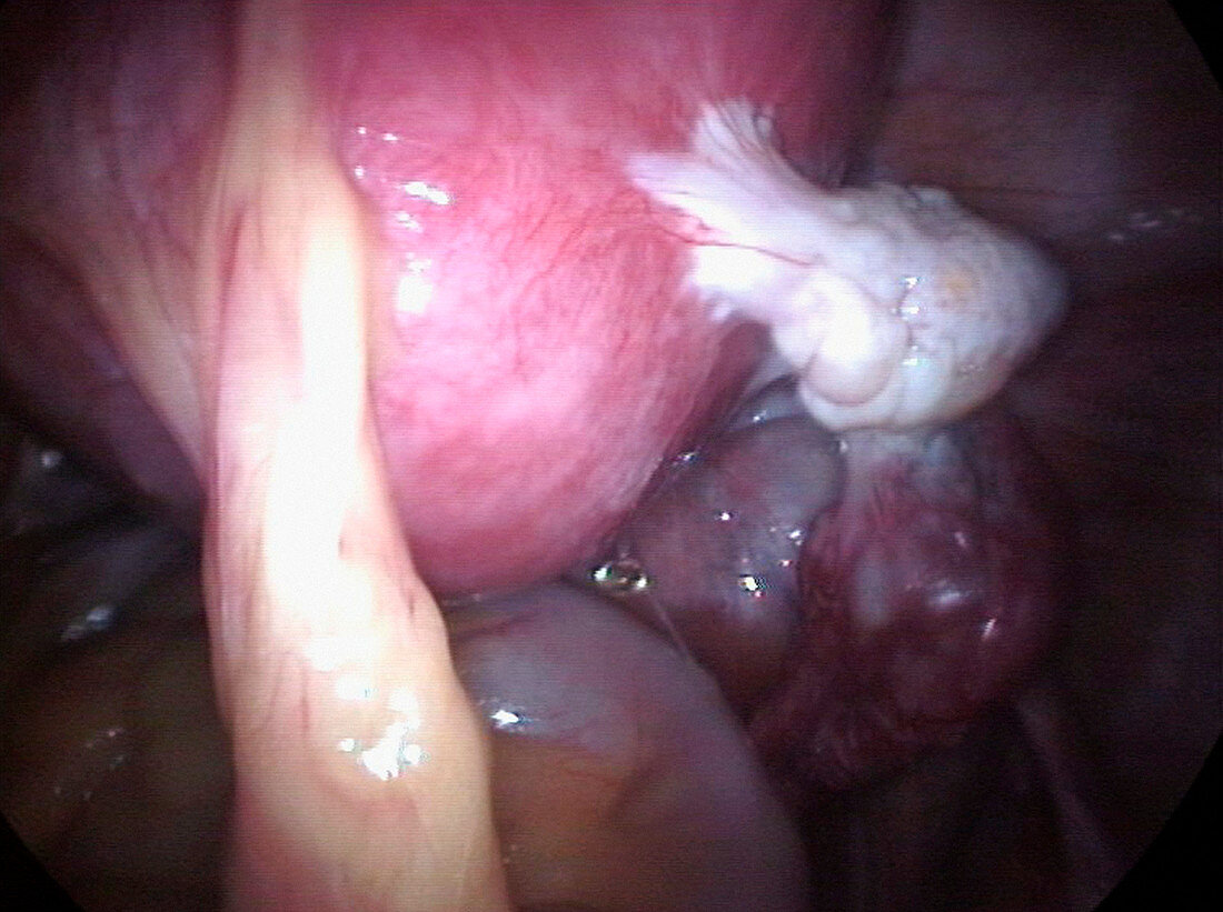Ovarian adhesions to the uterus