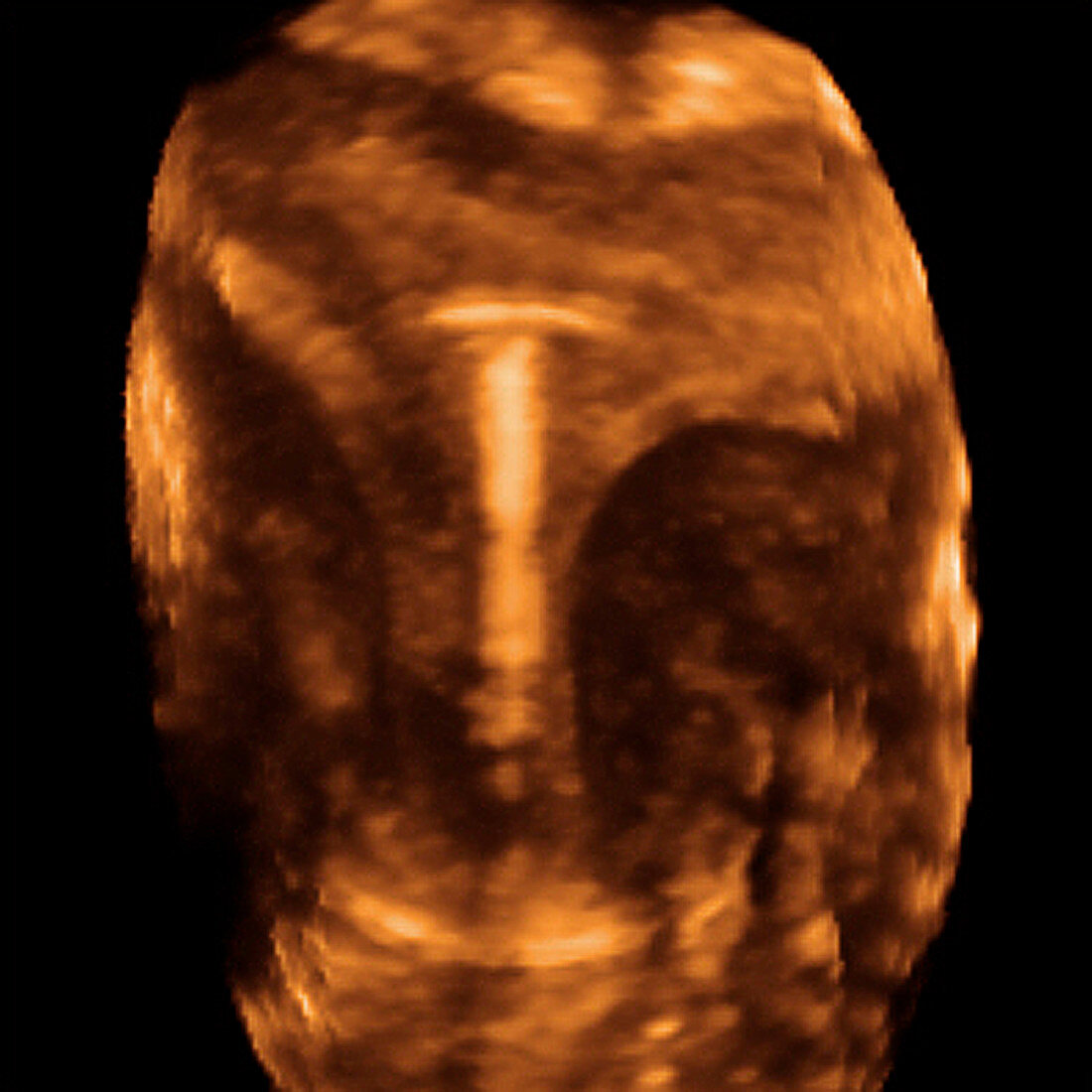 IUD contraceptive,ultrasound scan