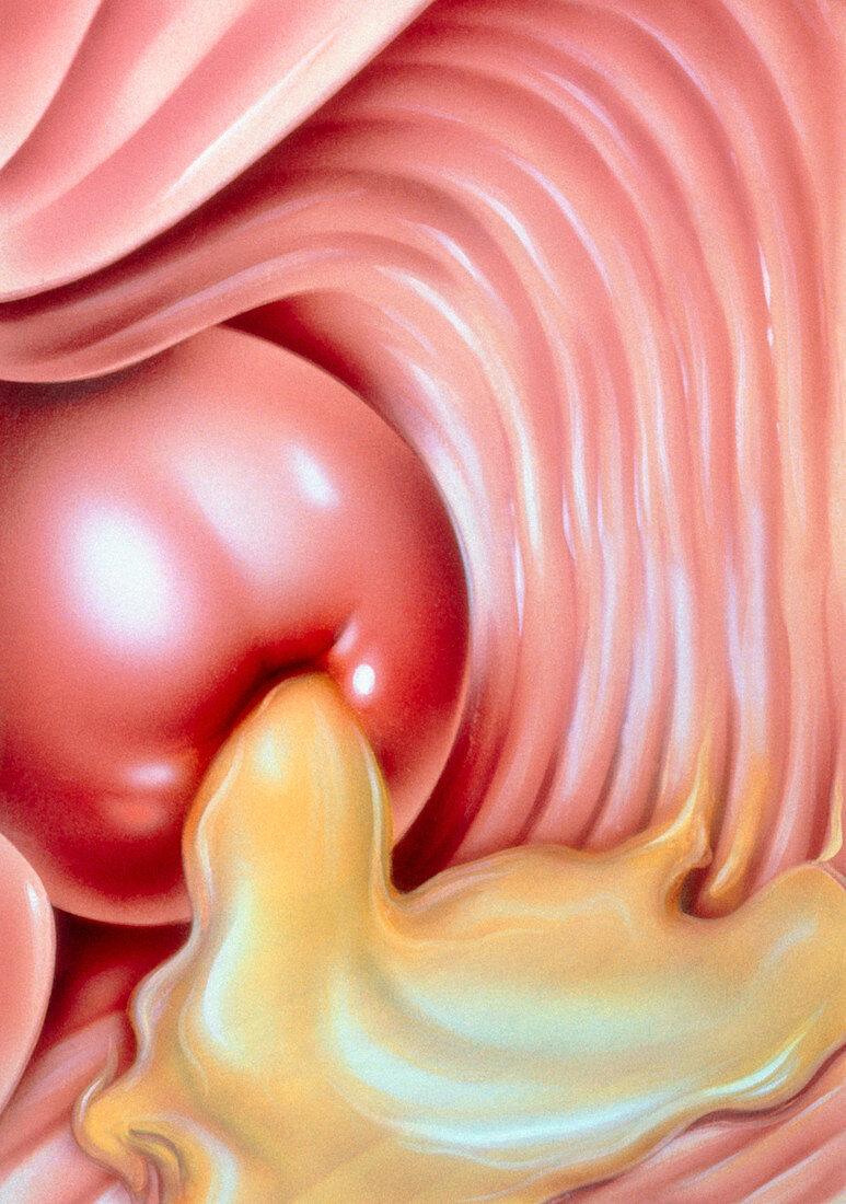 Illustration of gonorrhoea of the cervix