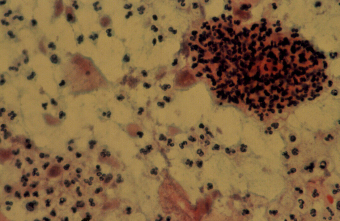 LM of cervical smear infected with Trichomonas