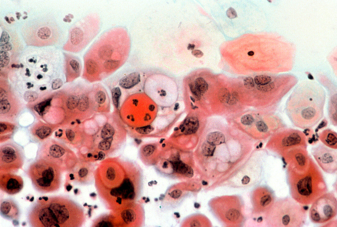 LM of cervical smear showing Chlamydia infection