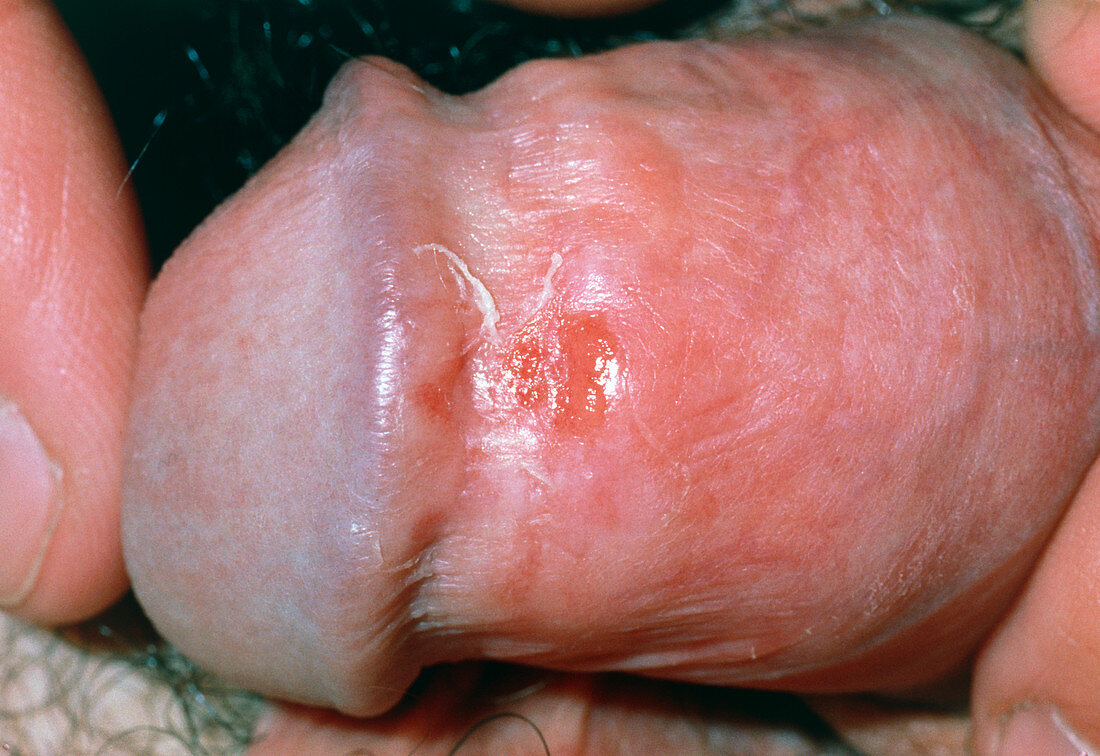 Close-up of penis with herpes simplex blisters