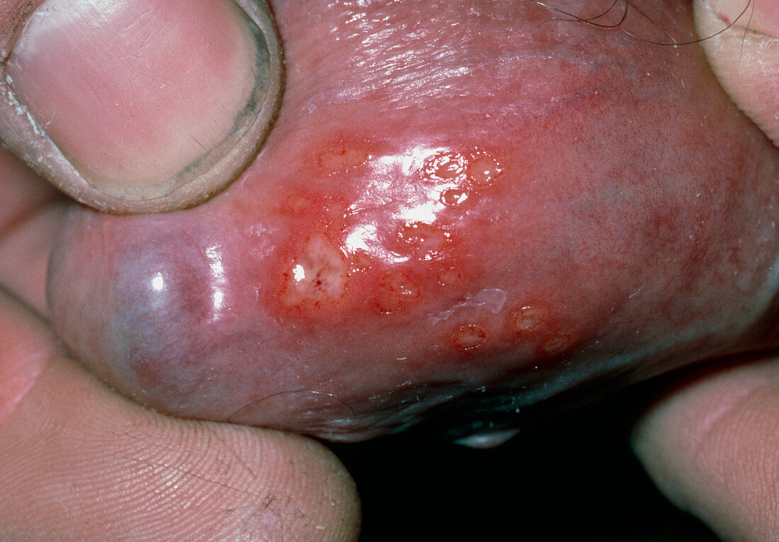 Close-up of penis affected by herpes simplex