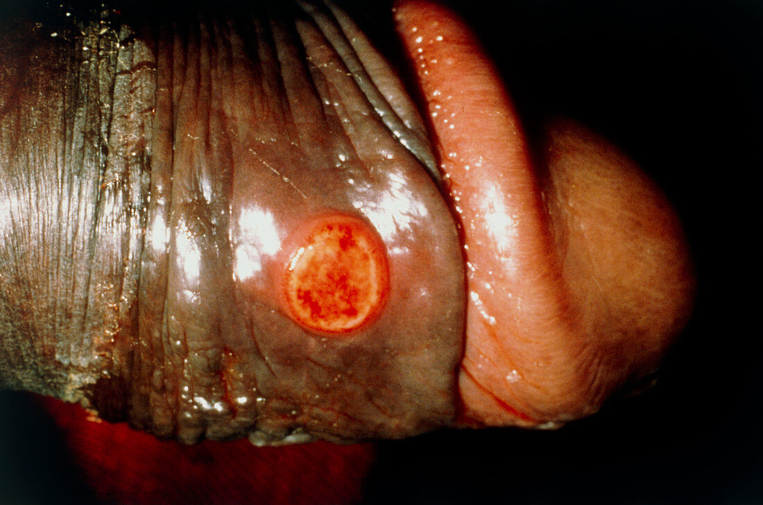 Syphilis chancre on penis