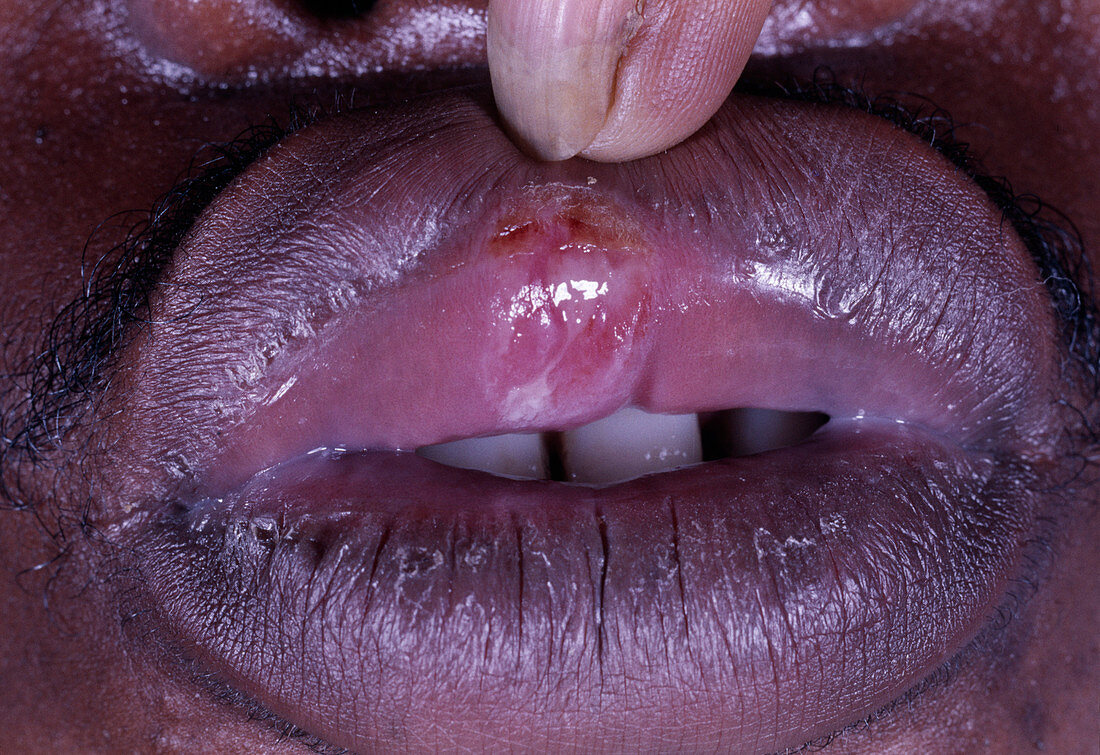 Syphilis lip ulcer