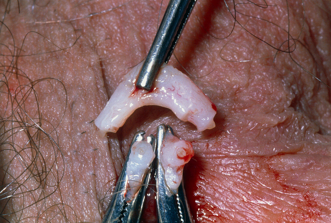 Removing vas deferens during a vasectomy operation