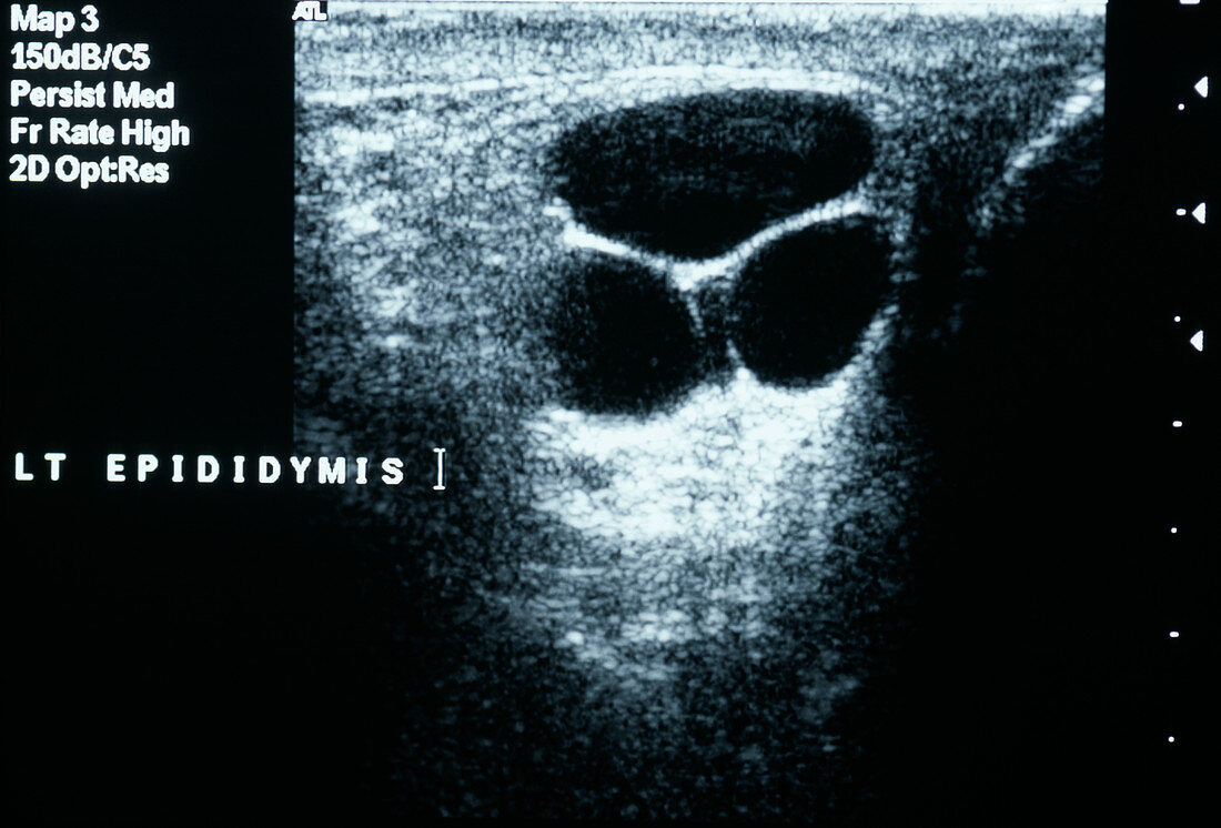 Testicular cysts,ultrasound scan