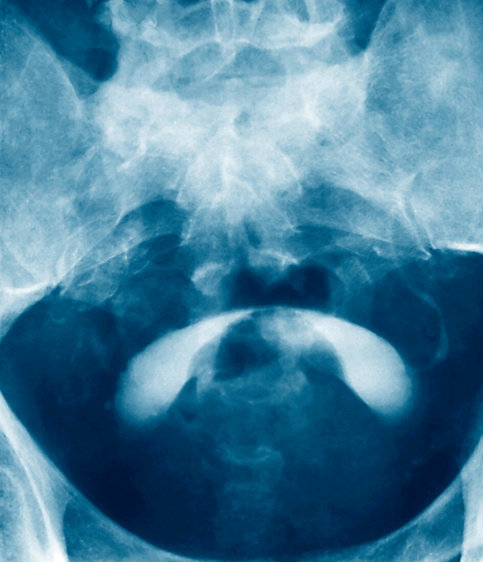 Prostate tumour,X-ray