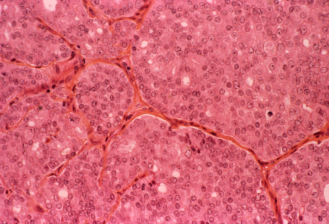 Prostate cancer,light micrograph