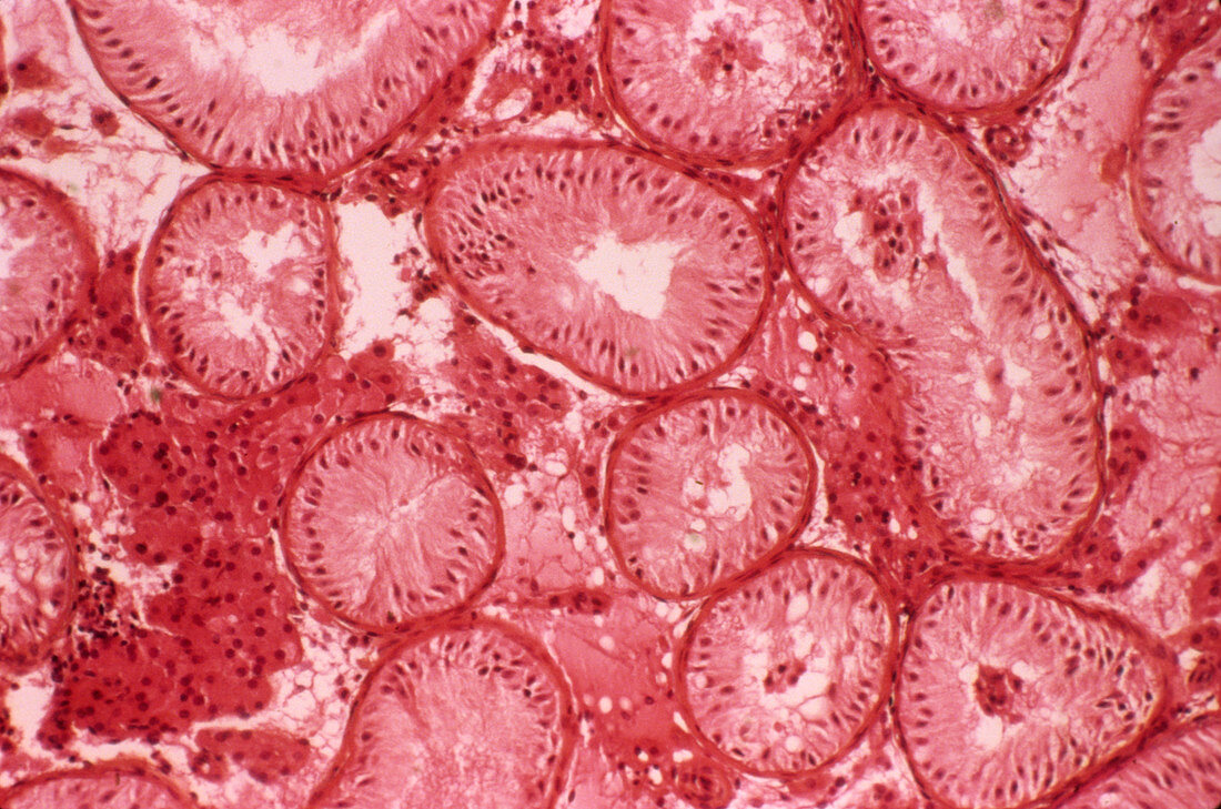 Male infertility,light micrograph