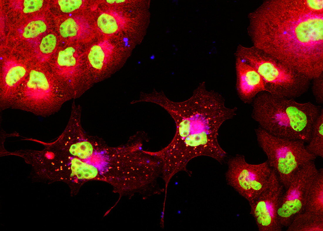 Prostate cancer cells