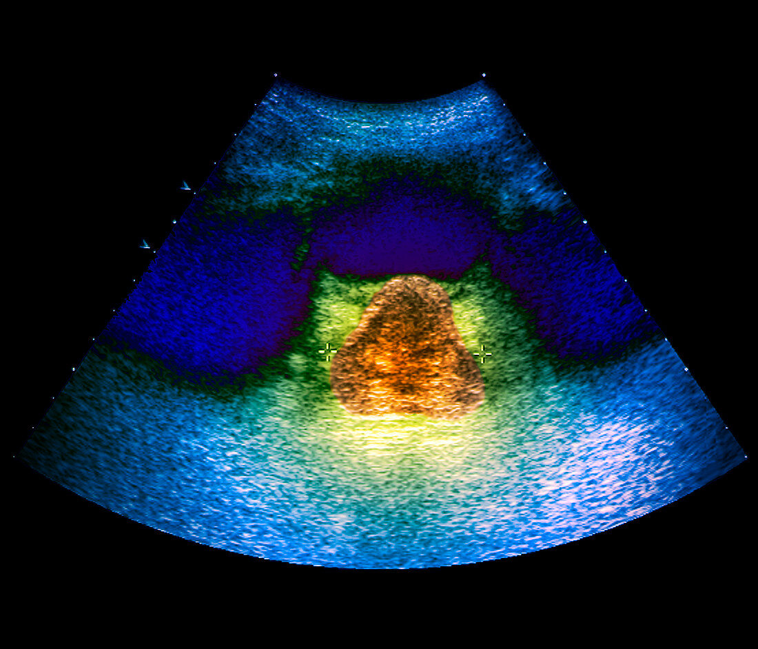 Prostate tumour,ultrasound scan