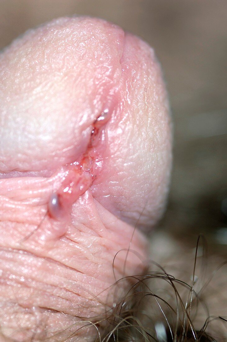 Injured penis,torn frenulum