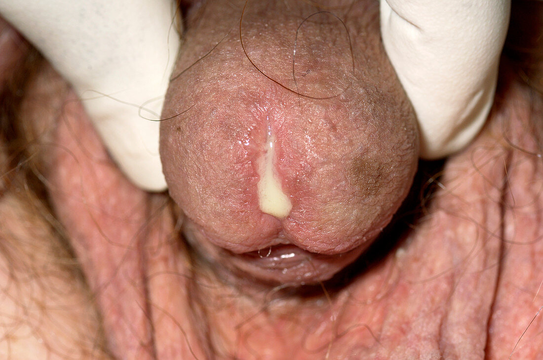 Gonorrhoea infection