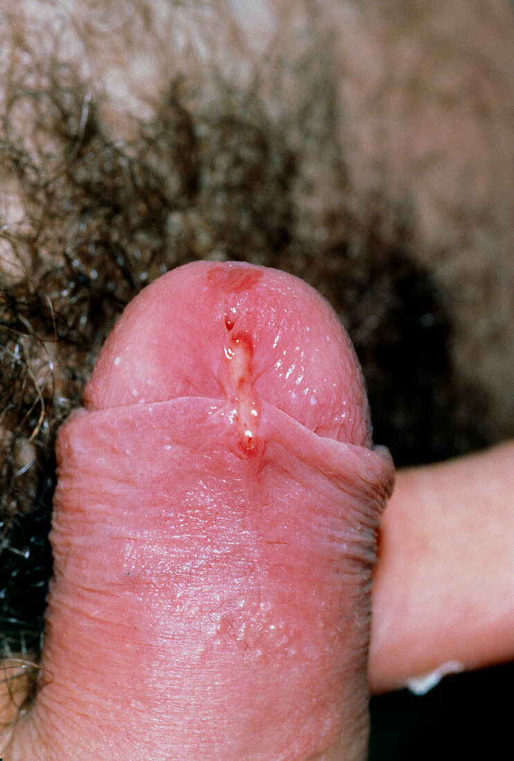 Torn foreskin of penis due to sexual intercourse