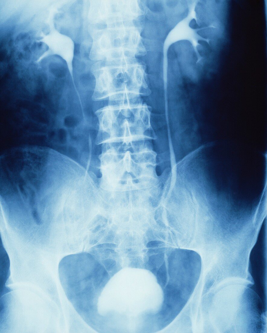IVU showing enlarged prostate