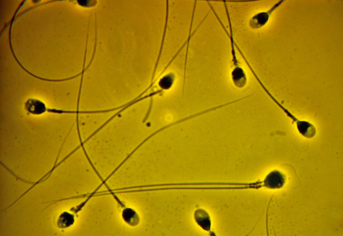 LM of human sperm,showing one with two tails