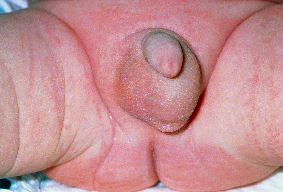 Baby with hydrocele and undescended testis