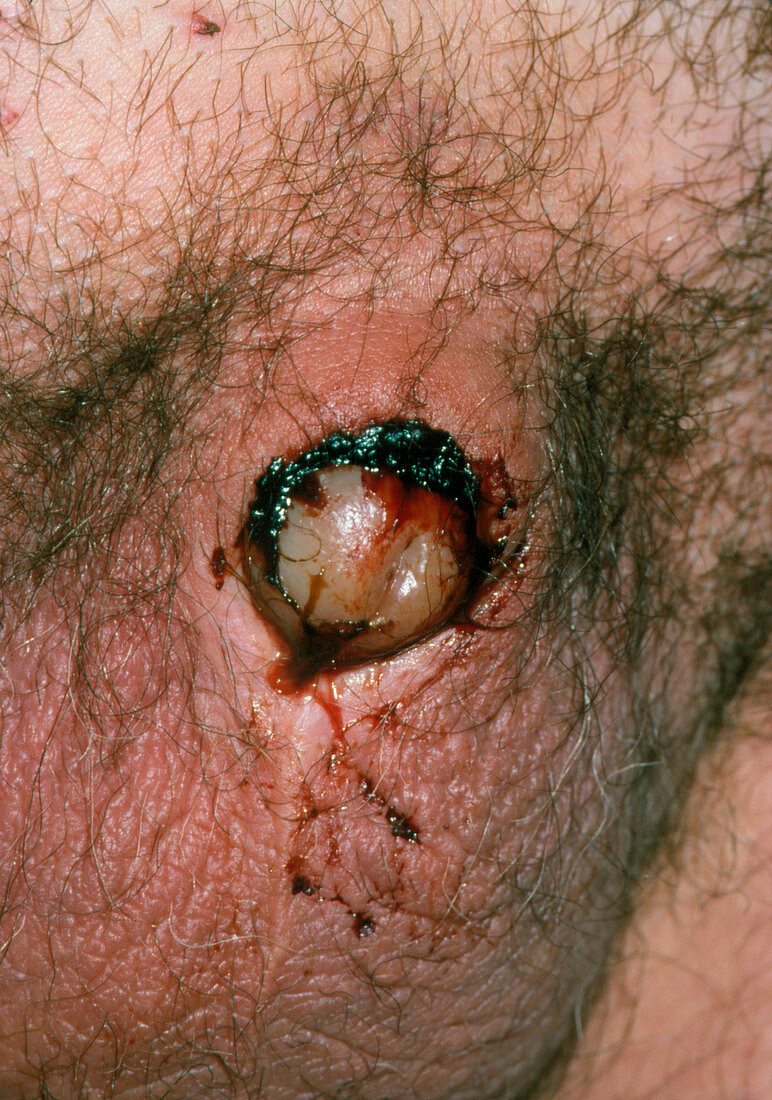 Close-up of infected wound following circumcision