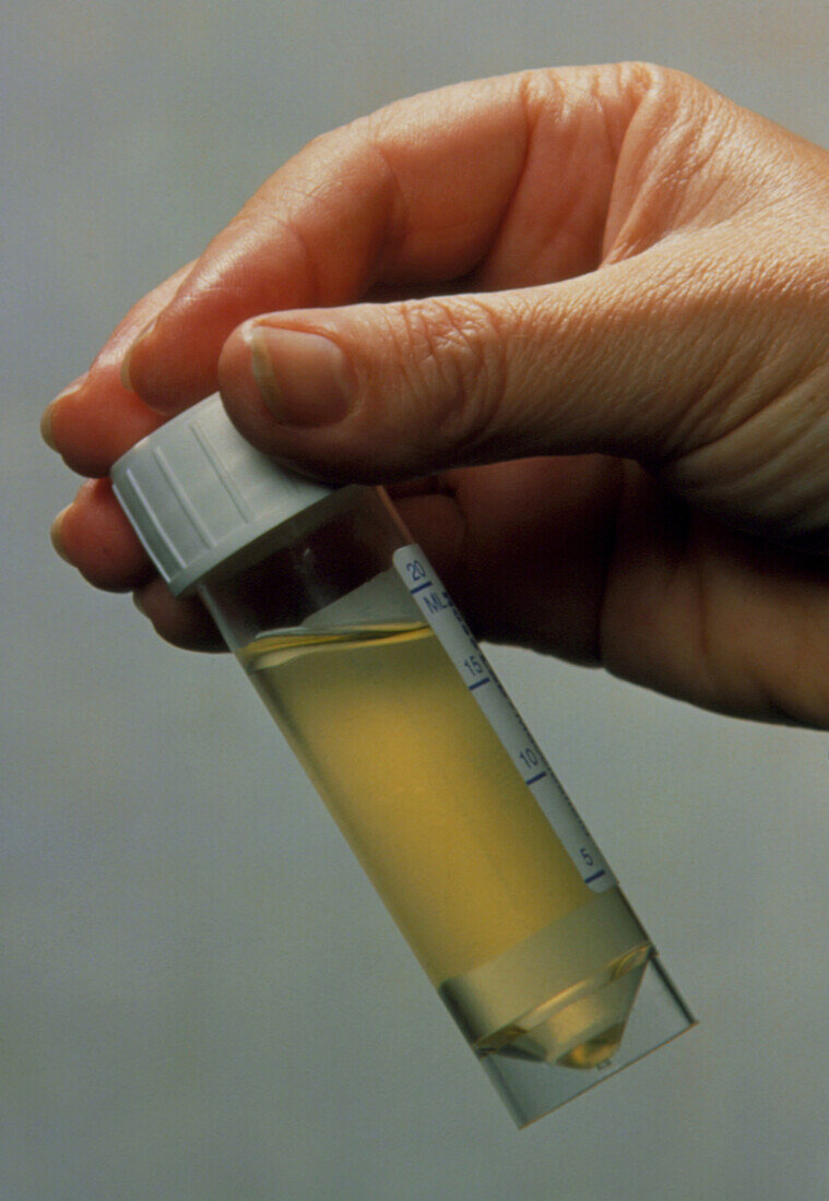 Plastic sample bottle with urine