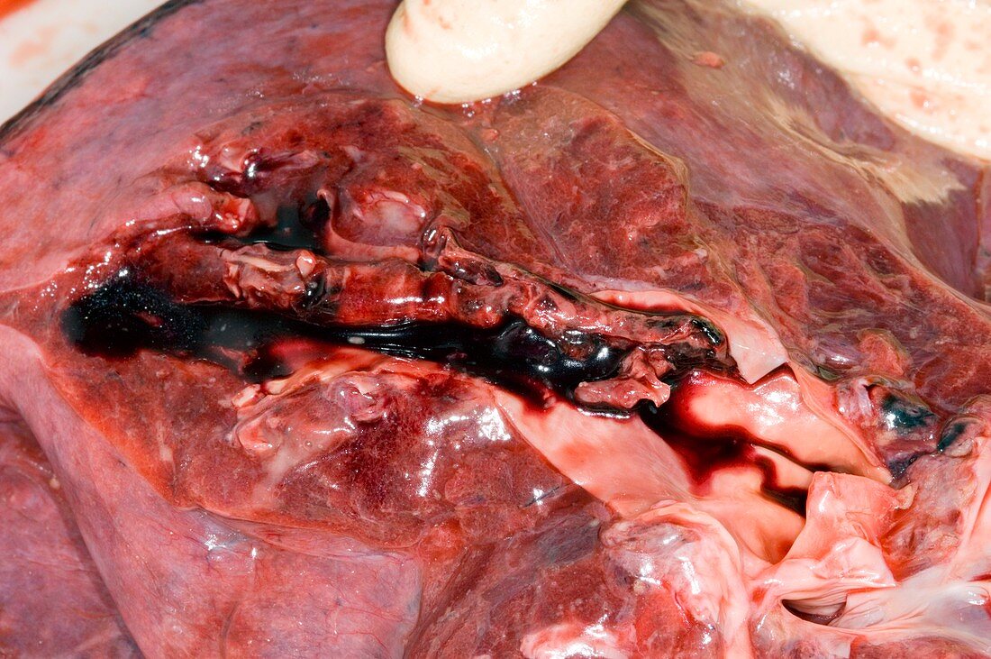 Lung blood clot,post-mortem