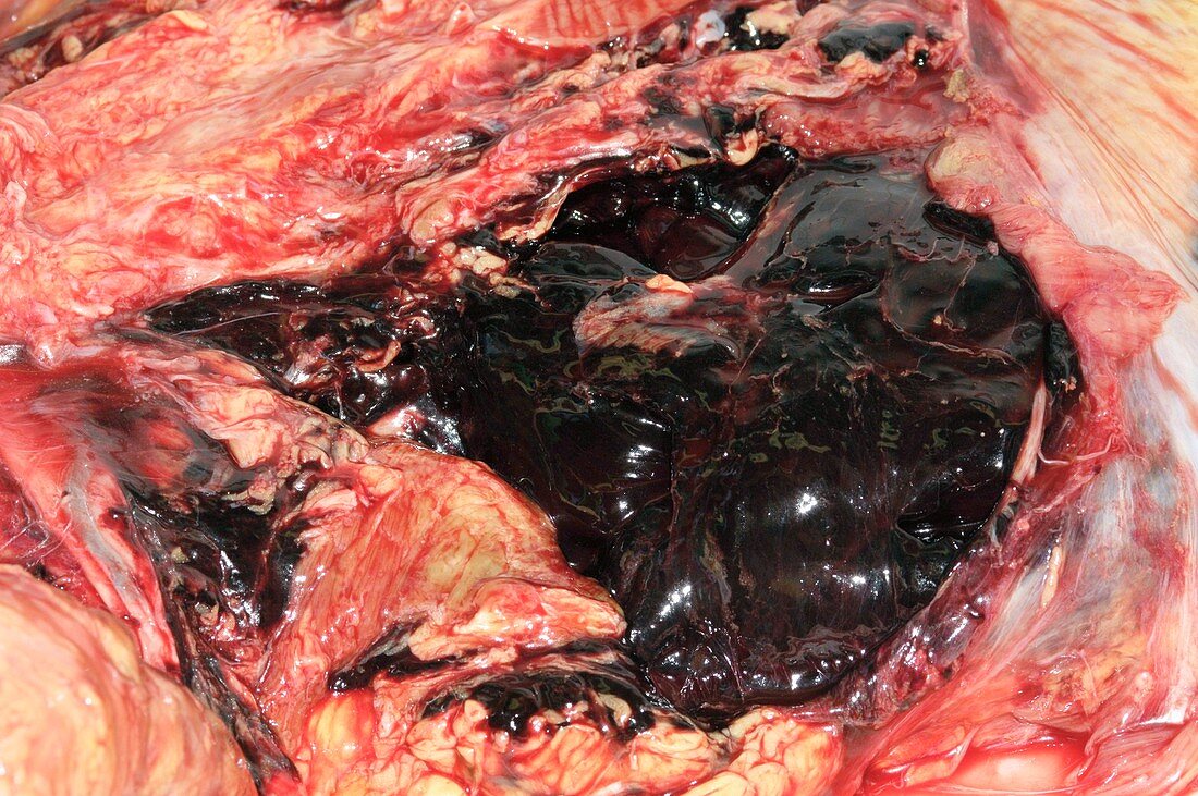 Ruptured aortic aneurysm,post-mortem