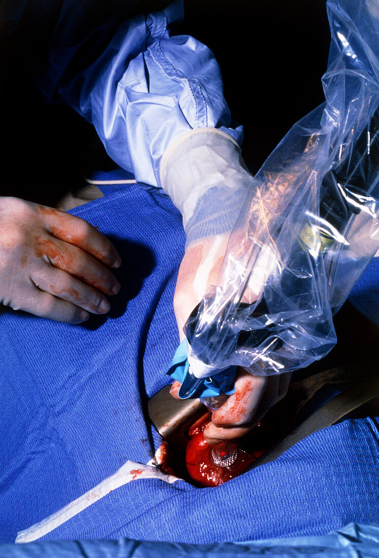 Surgeon using a laser during heart surgery