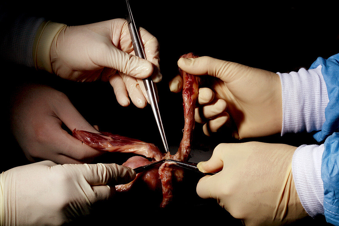 Autopsy examination of shoulder tendons