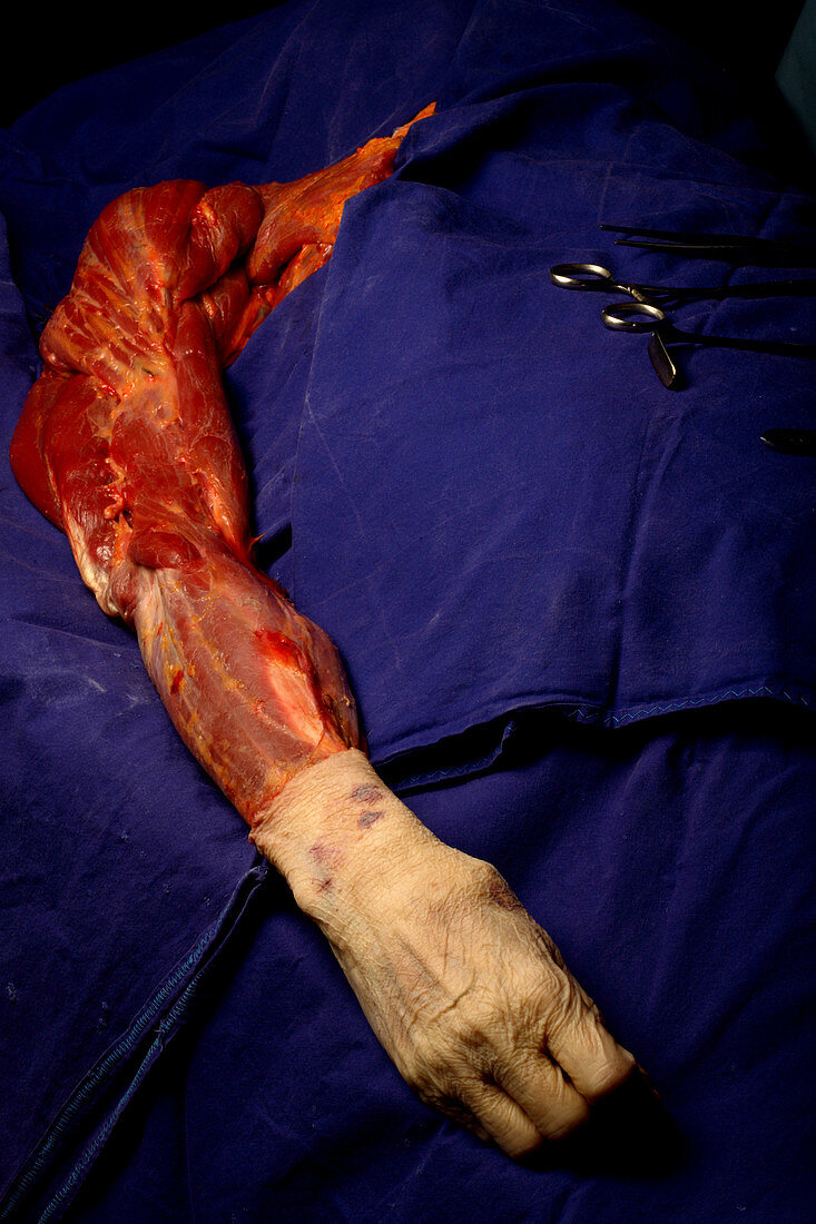 Dissected arm of a corpse