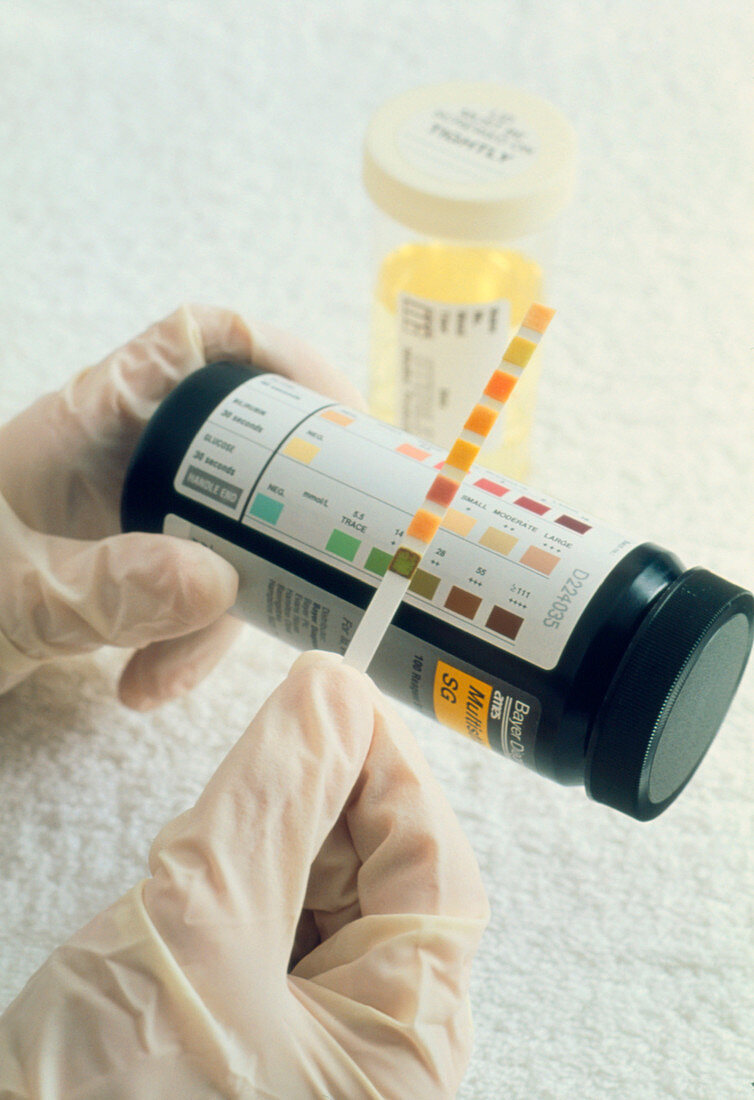 Urine analysis: multiple test stick & urine sample