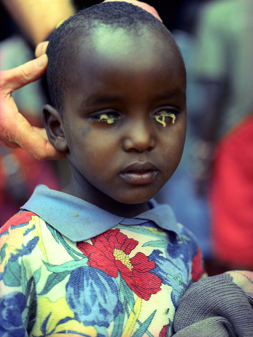 Trachoma eye infection treatment