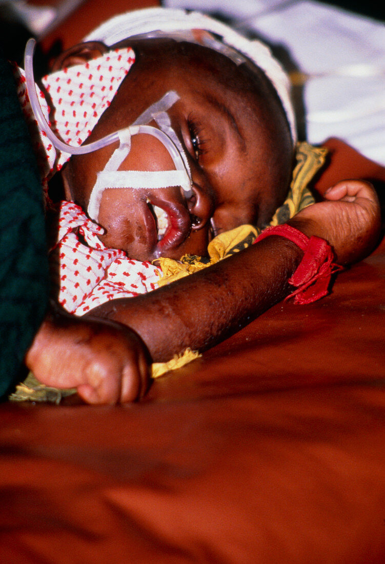 Young child with malaria in Tanzanian hospital