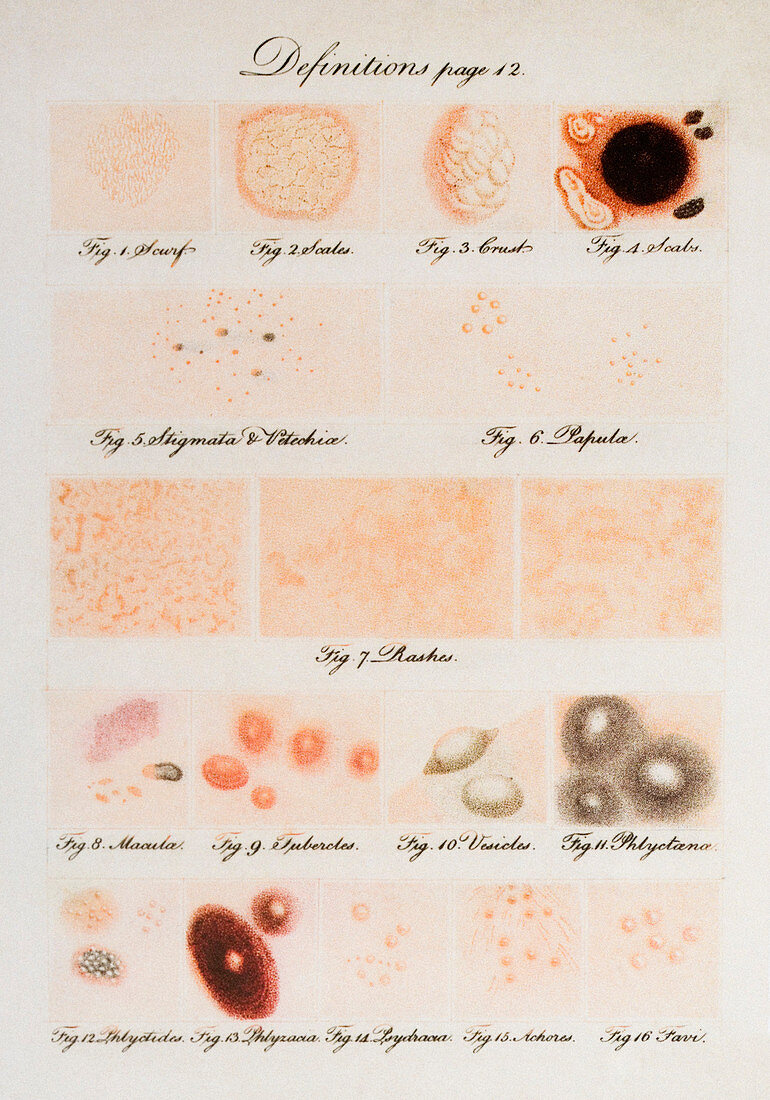 Skin lesions