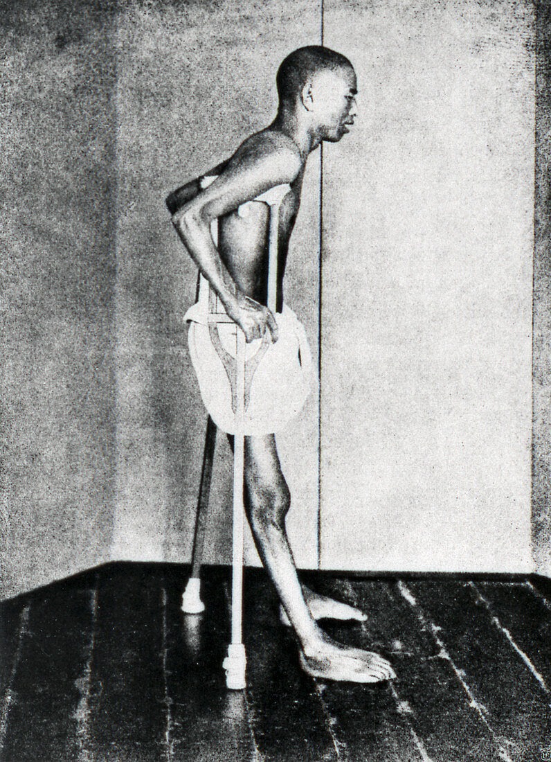 Beriberi patient,1914