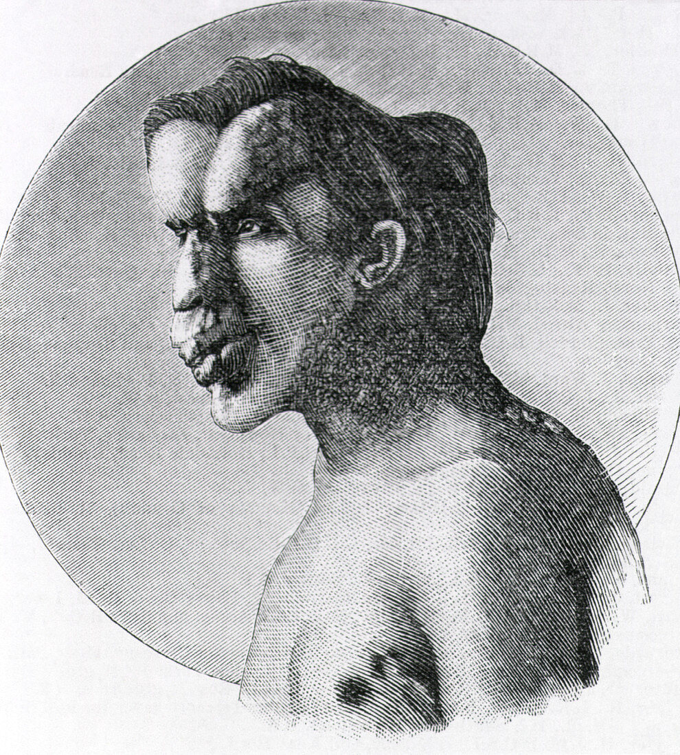 Joseph Merrick,The Elephant Man