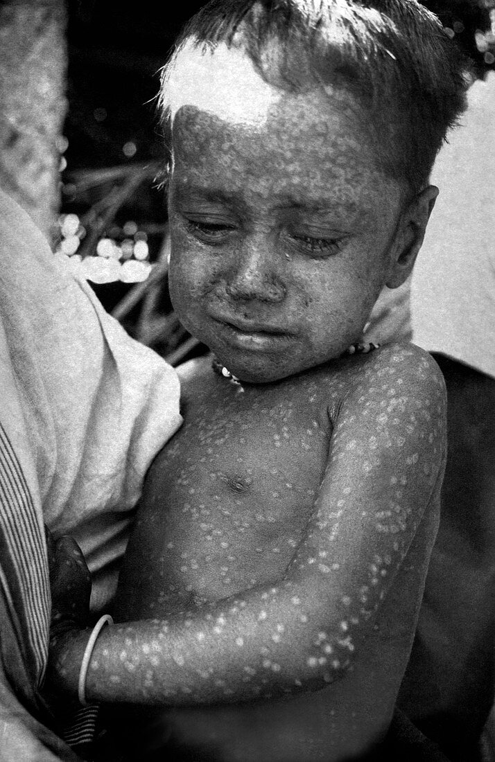 Last smallpox major infection,1975