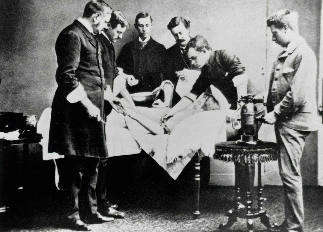 Early surgery (1883) using carbolic acid spray