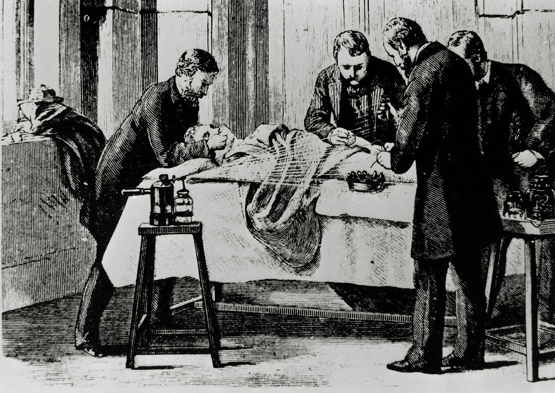 19th century surgery using antiseptic spray
