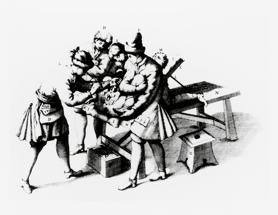 Engraving of a lithotomy operation being performed