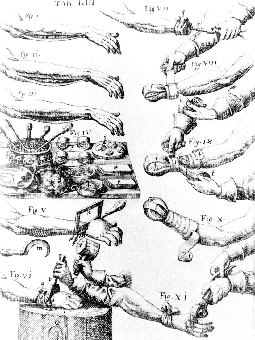 Historical artwork of 17th century arm surgery