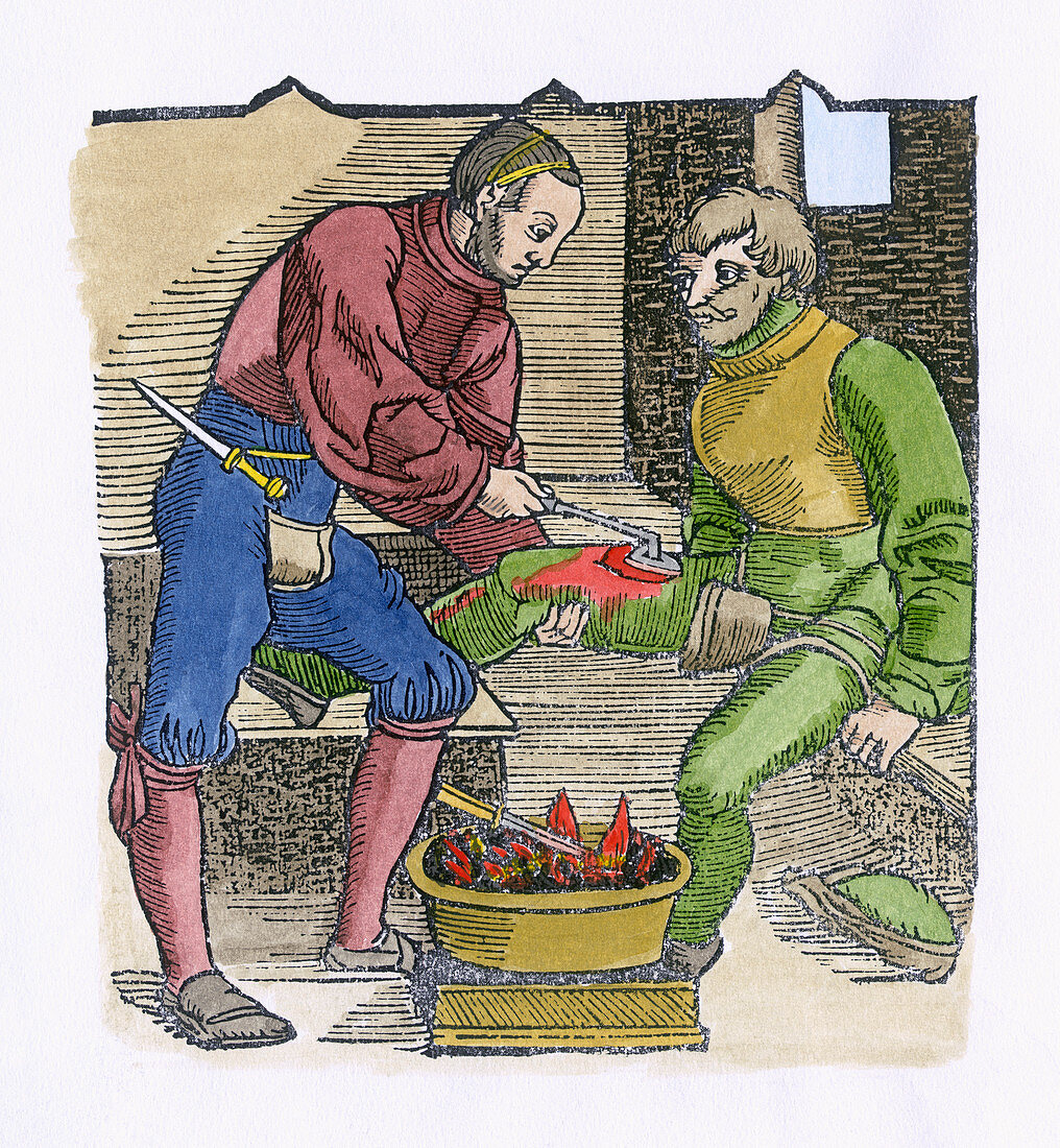 16th century wound cauterization